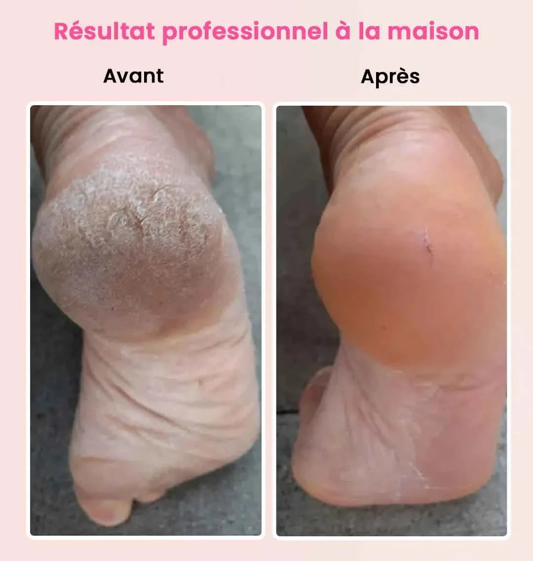 LIMEPLUS™ : La lime à pied électrique ultra doux, rechargeable et facile d'utilisation. Avec ça plus de talon calleux